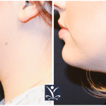 Before and After CoolSculpting Chin RMD