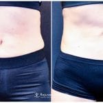 Before&AfterCoolSculptingRMD copy