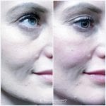 Before&AfterTearTroughFillerRM