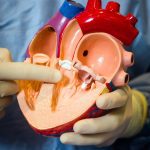 Mitra Clip in heart model, PeaceHealth St. Joseph Hospital Cath