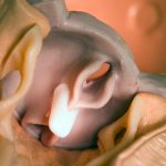 Mitra Clip in heart model, PeaceHealth St. Joseph Hospital Cath