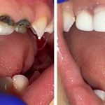 treatment-and-after