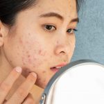 Conceptual shot of Acne & Problem Skin on female face.